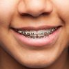L’orthodontie adulte, quelle prise en charge ?